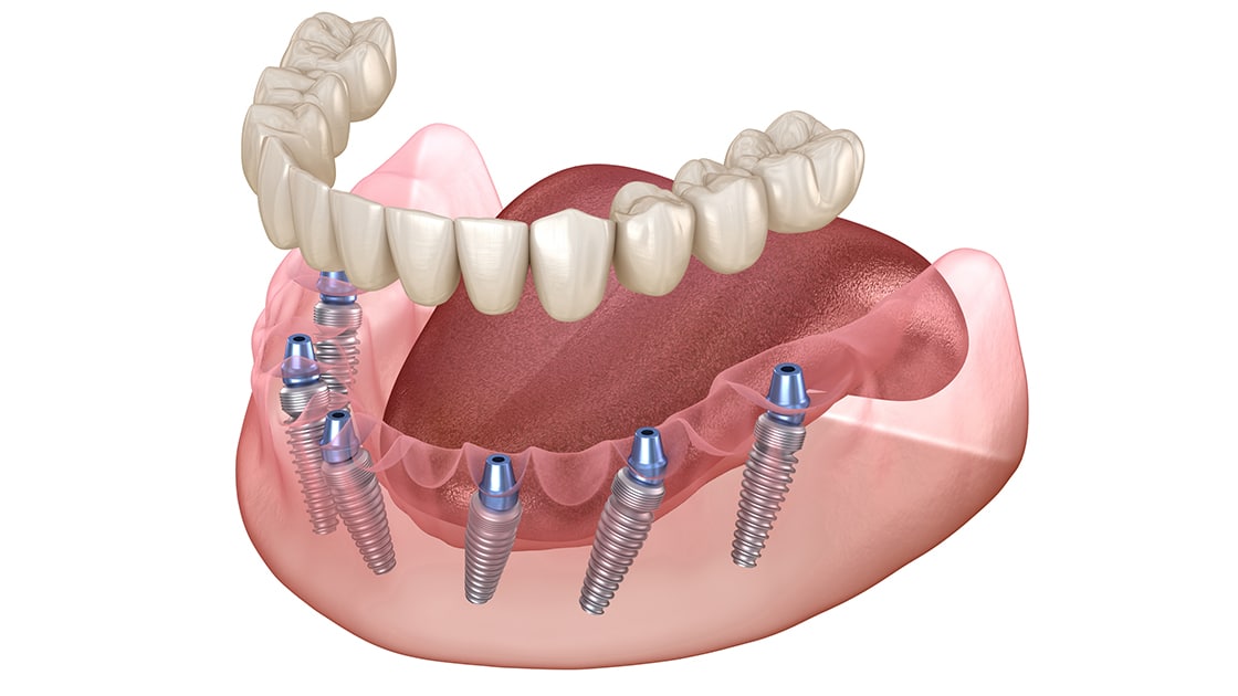 Implant Supported Dentures
