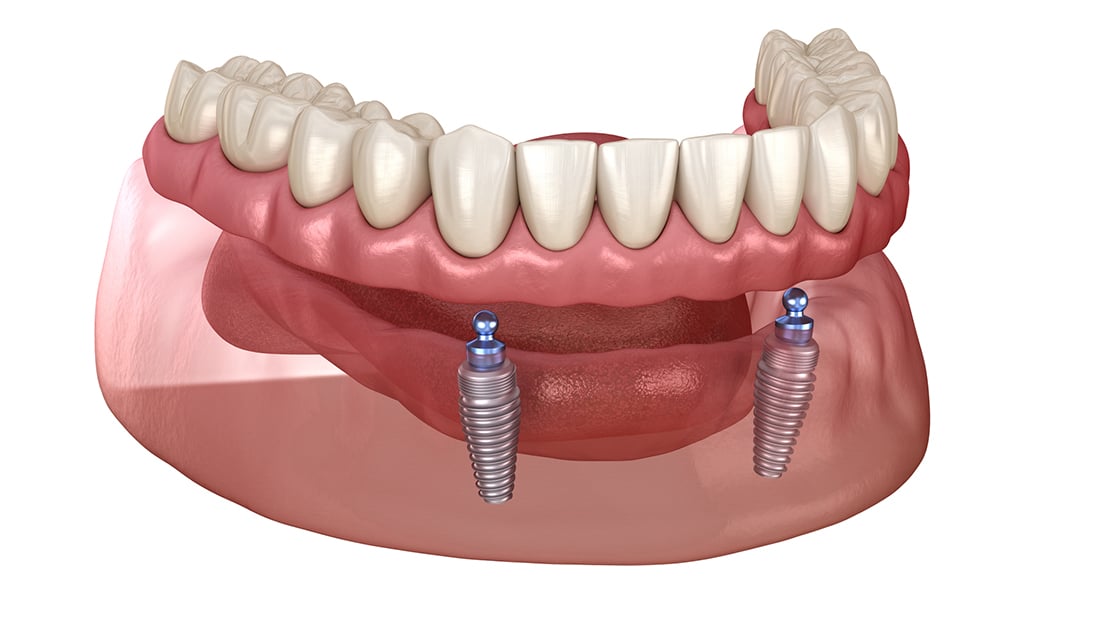 Implant Retained Dentures