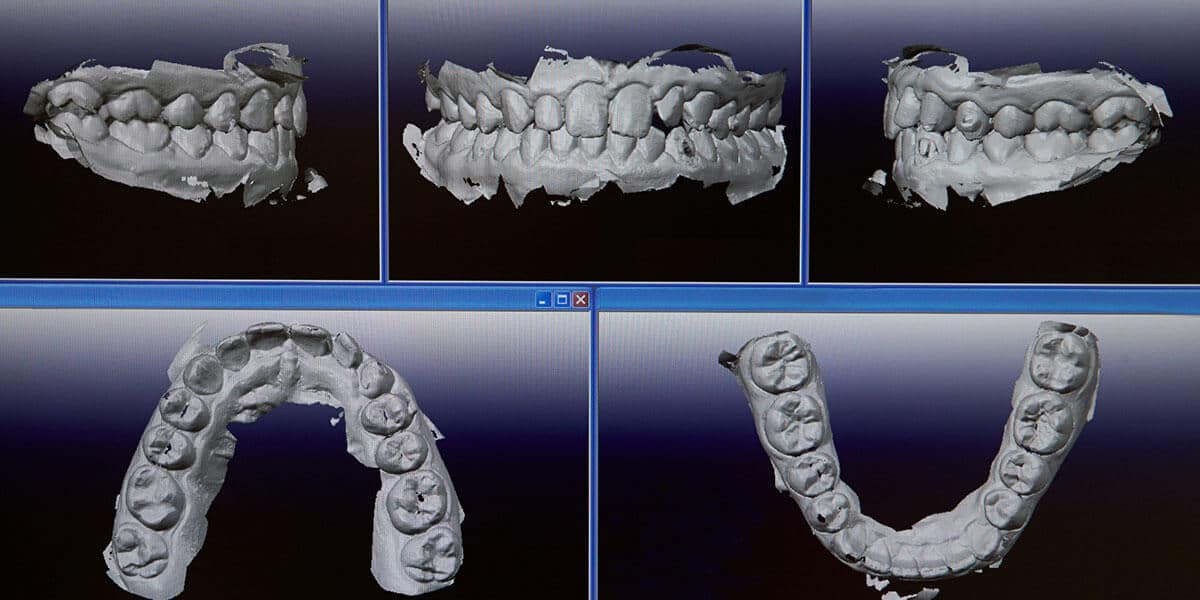 digital intraoral scanner