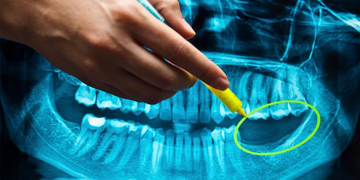 Dental Implant Benefits Graphic