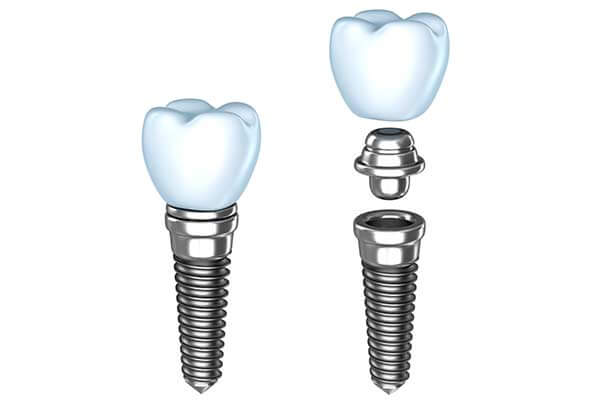 Dental Implant