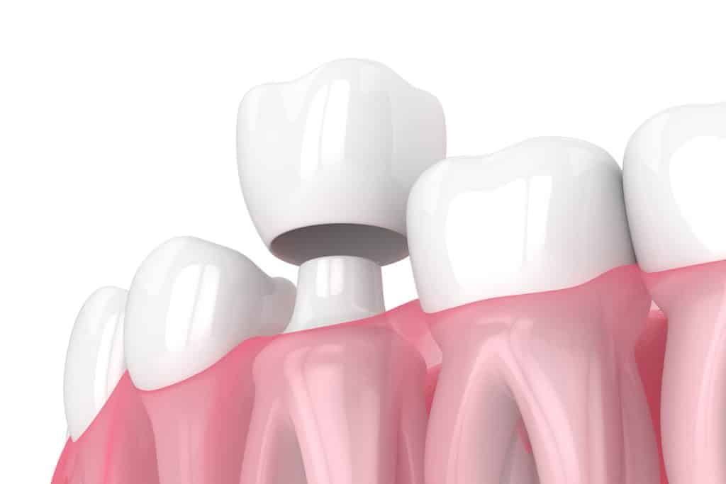 How to Care for Your Dental Crown to Make It Last