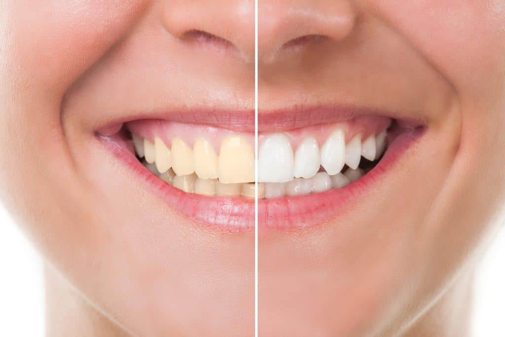 How to Maintain Whiter Teeth After a Whitening Treatment