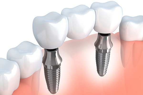 Implant Support bridge