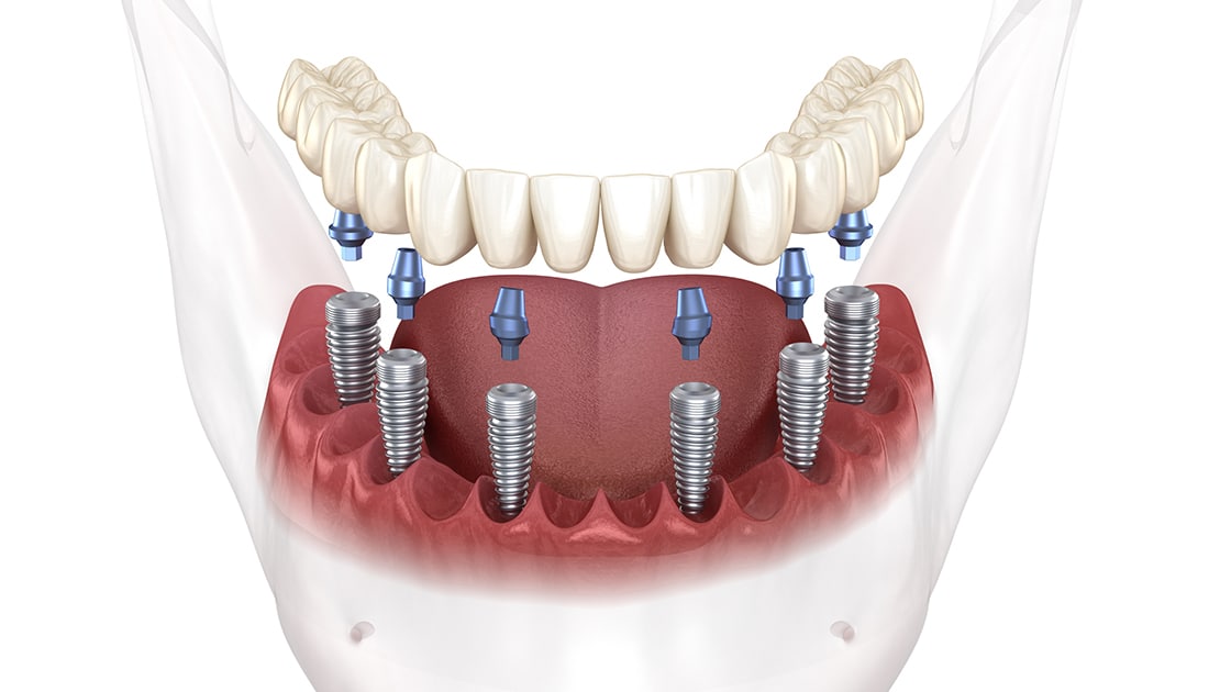 Implant Support Dentures