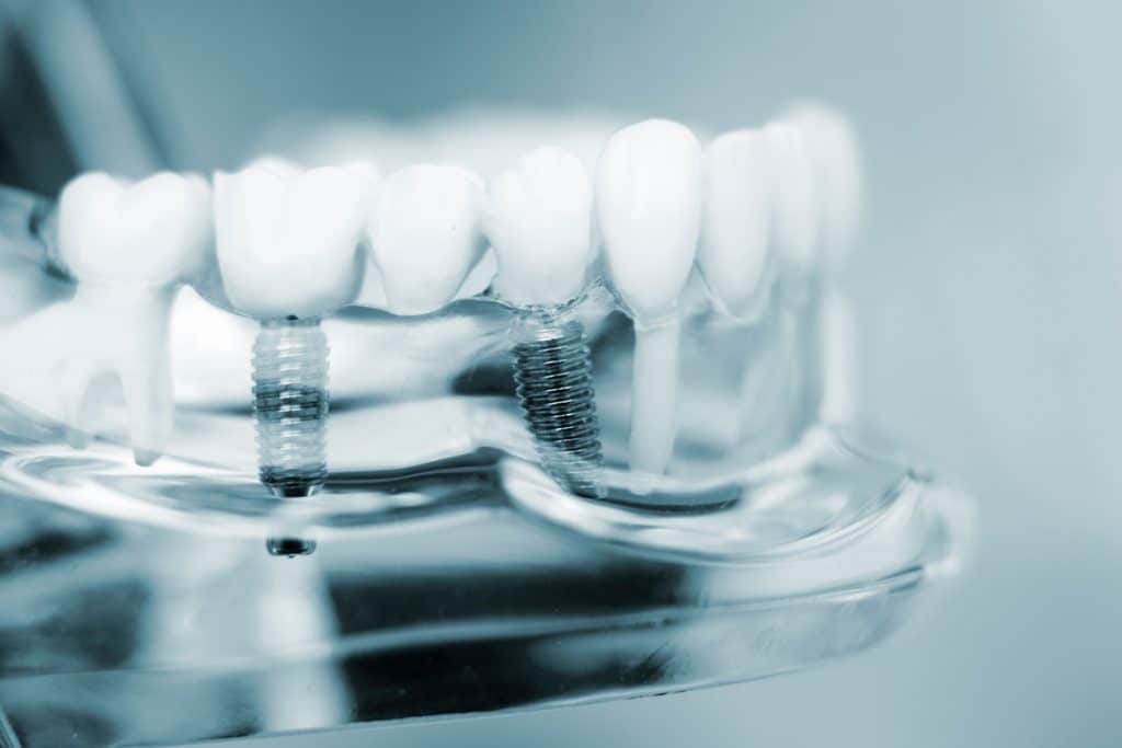 What is- Dental Implant