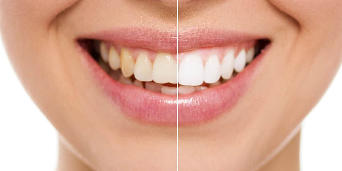 teeth whitening before and after comparison